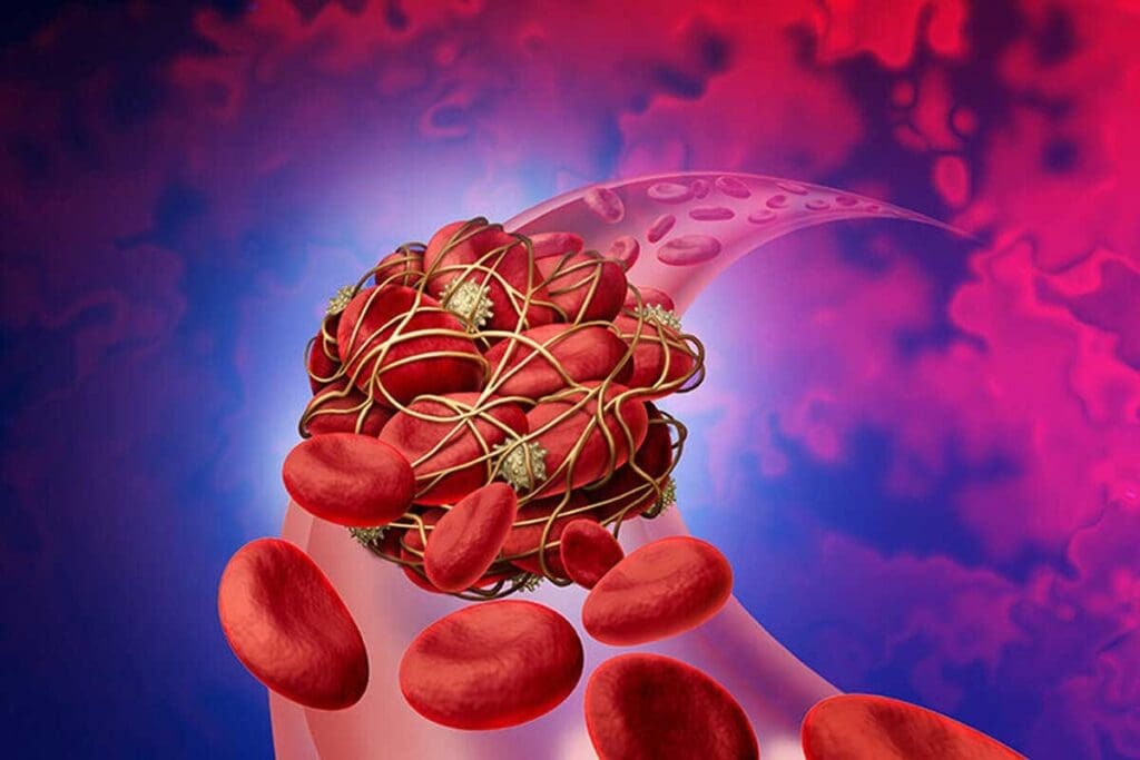 11 Key Facts About Blood Clot in Artery: Causes, Symptoms, and Risks
