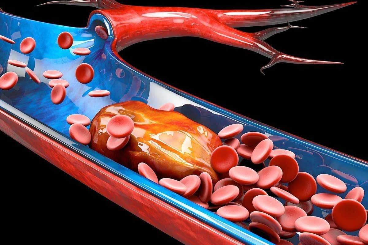 What Does Thrombus Mean in Medical Terms?