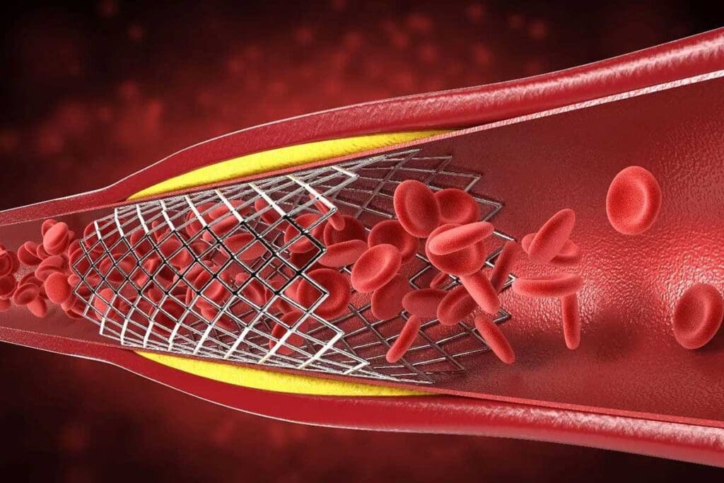What Does Thrombus Mean in Medical Terms?