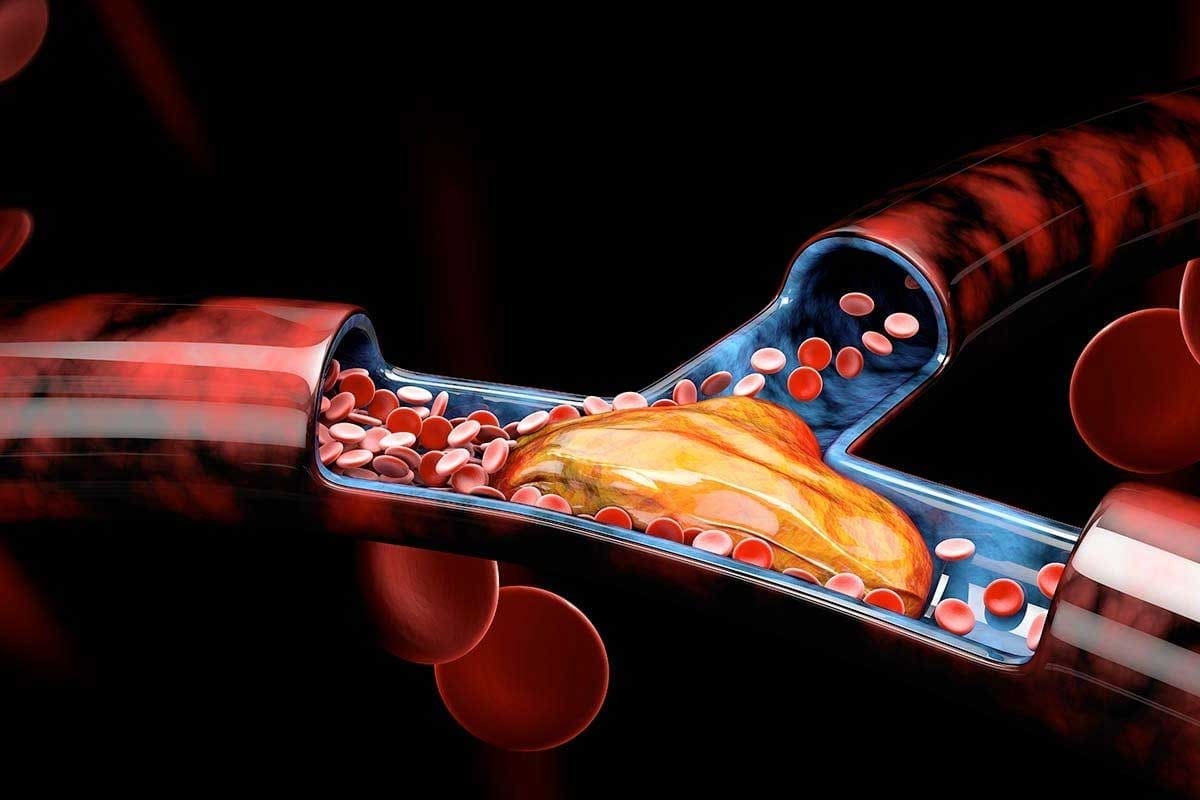 Define Thrombus: Medical Term, Meaning, and Key Facts Explained
