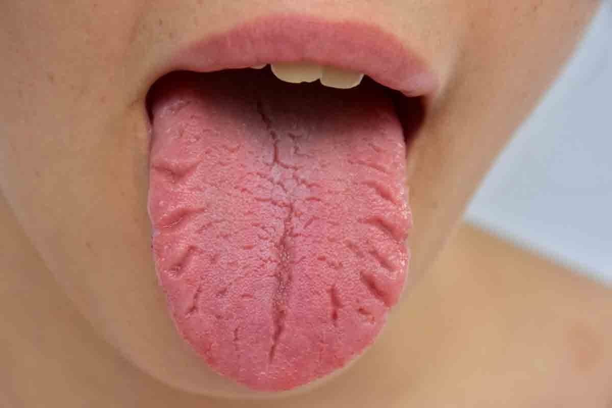 7 Key Anaemia Tongue Symptoms: How Iron Deficiency Affects Your Tongue