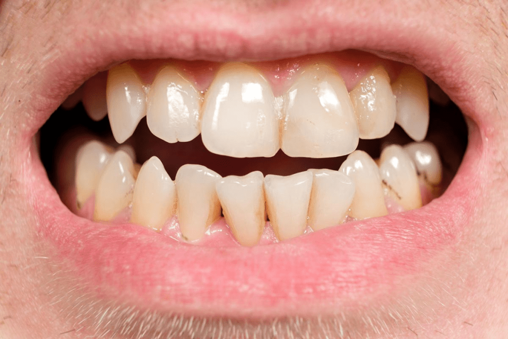 Tumour Teeth Effects: Terrible Dental Damage 1 Tumour Teeth Effects: Terrible Dental Damage