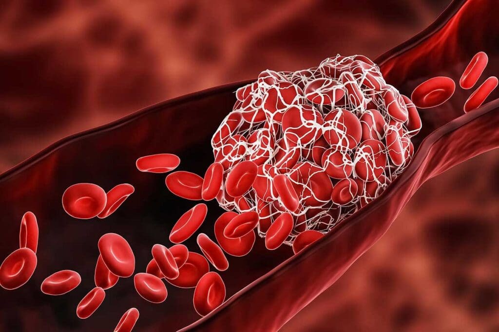 7 Different Kinds of Blood Clots Explained: Names, Characteristics, and Risks