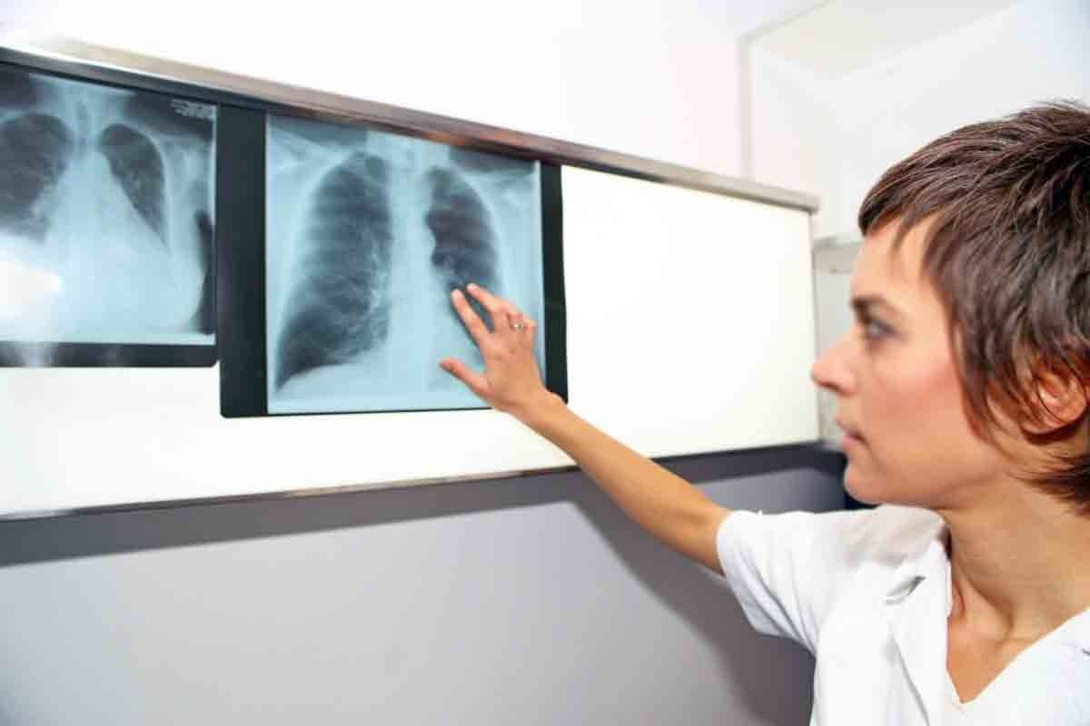 How Long Does a Pulmonary Embolism Last and What Are Its Symptoms?