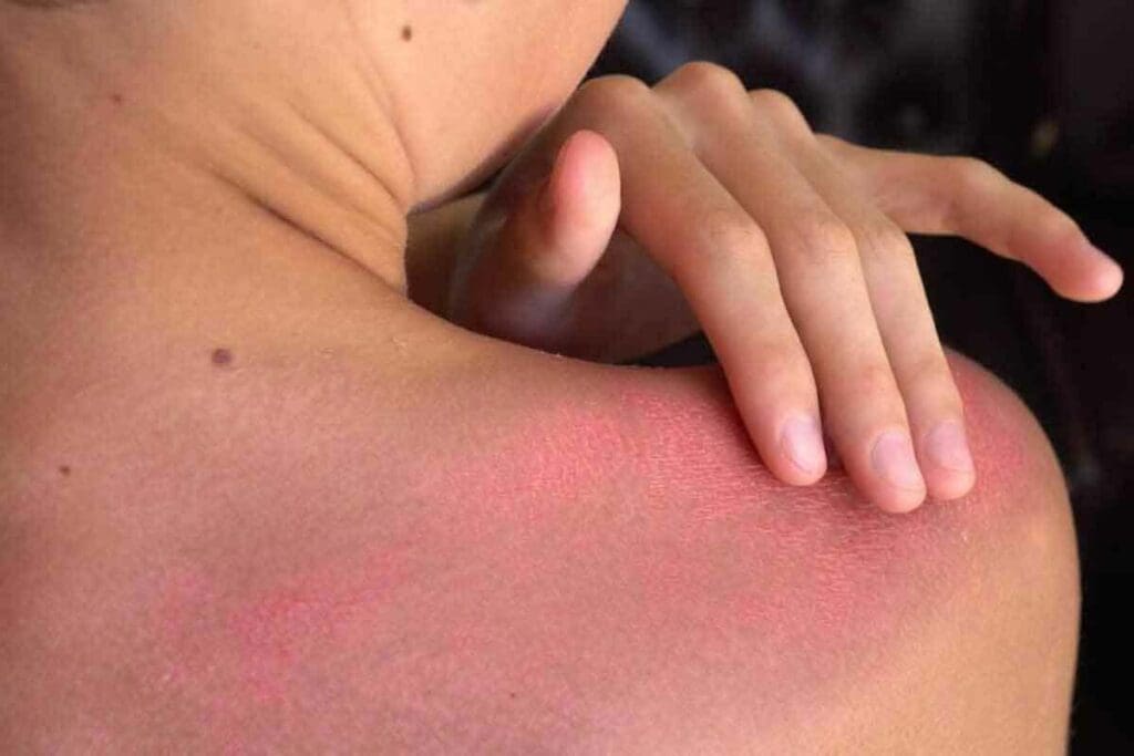 Treatments For Radiation Burns: 7 Essential & Effective Cures