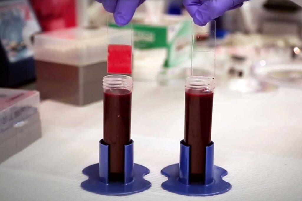 Blood Clot from Airplane: 5 Essential Tips to Travel Safely