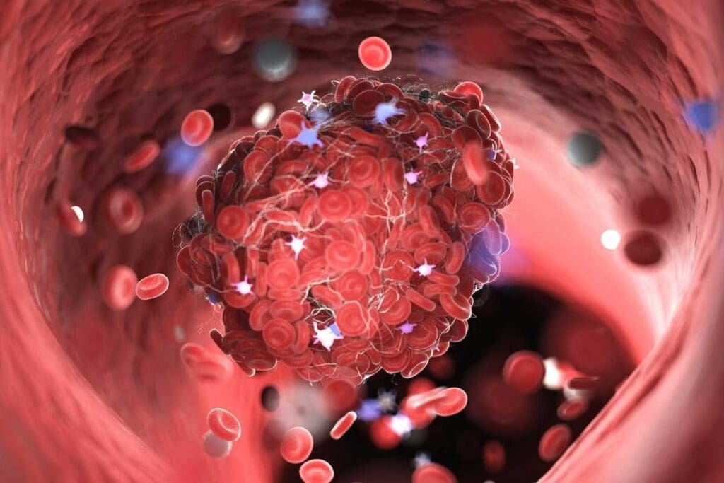 Blood Clot from Airplane: 5 Essential Tips to Travel Safely