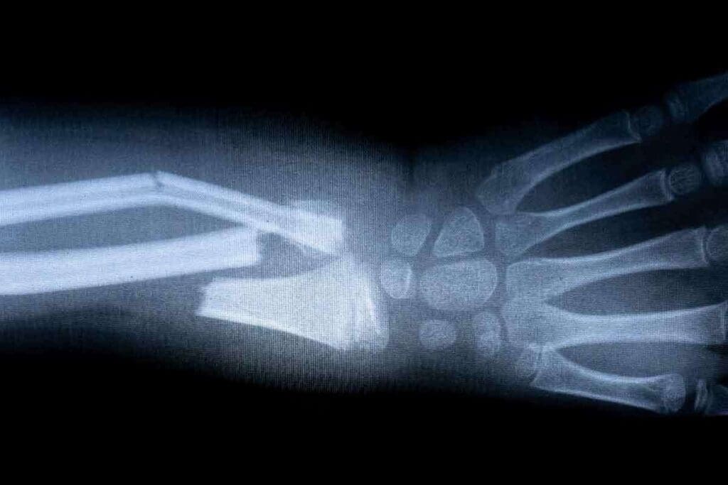 Can MRI See Broken Bones That X-Ray Cannot?