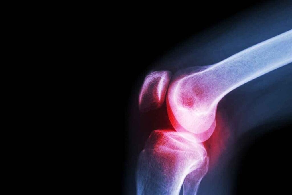 What Is the Treatment for Bone Marrow Cancer and Is It Curable? 1 What Is the Treatment for Bone Marrow Cancer and Is It Curable?