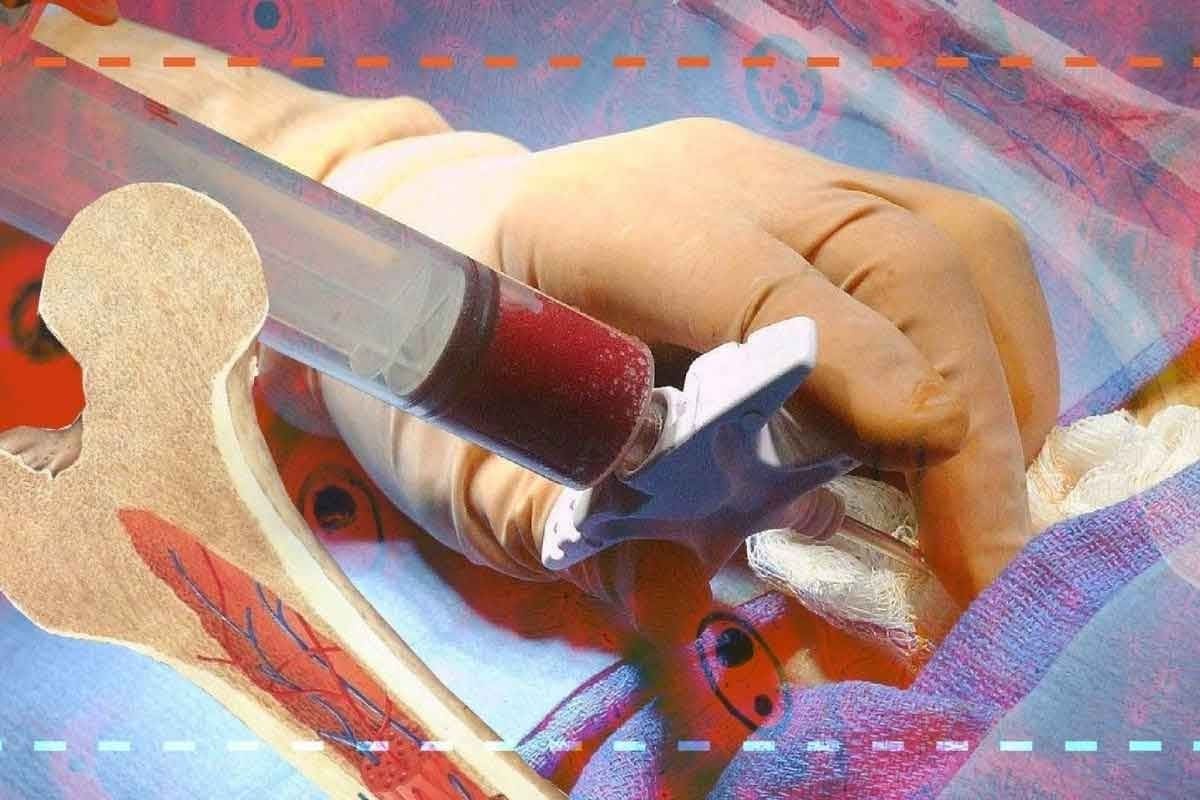 How to Treat Bone Marrow Cancer: Step-by-Step Treatment Options and Outlook
