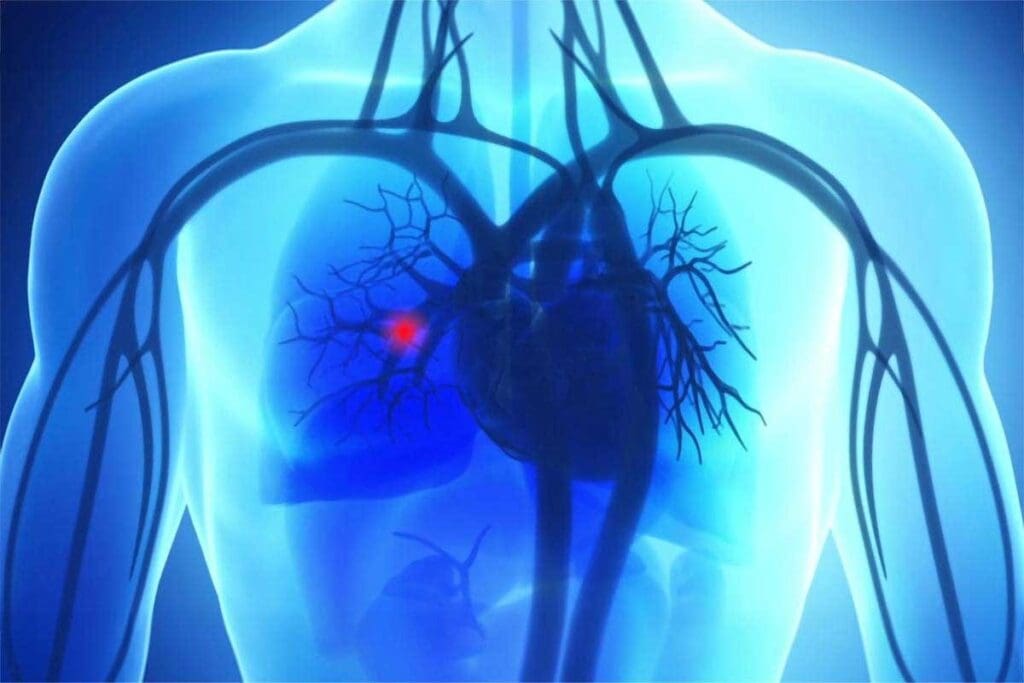 Pulmonary Embolism Pregnancy: 7 Key Symptoms You Shouldn’t Ignore 1 image 4090 LIV Hospital