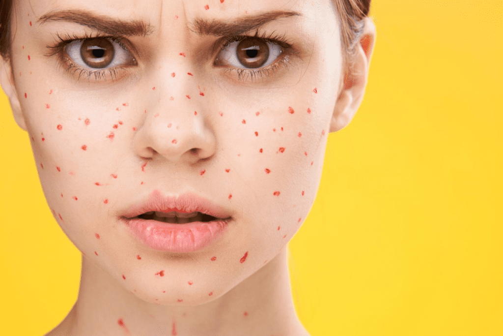 Chickenpox Thrombocytopenia: Negative Link Explained