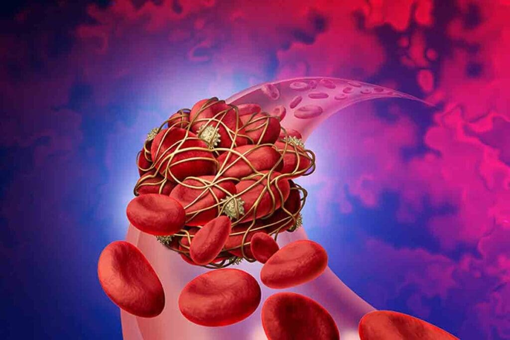 12 Blood Clot Causes & Warning Signs: What Causes Blood Clots and How to Spot Symptoms Fast