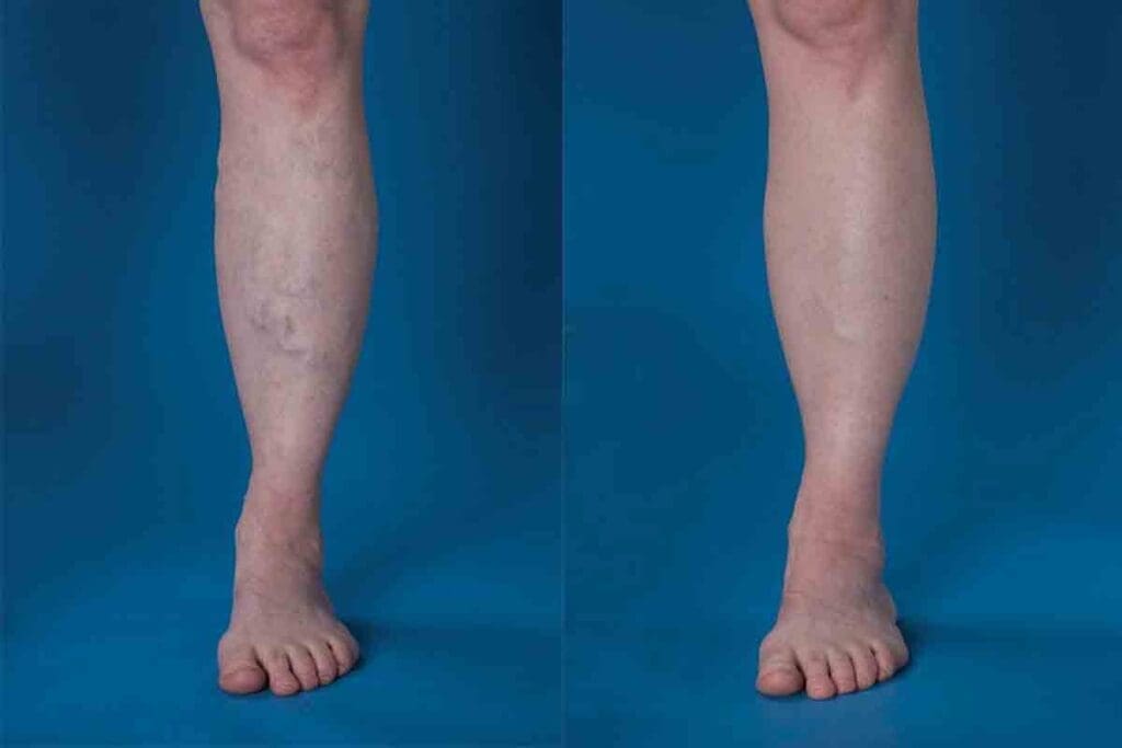 What Does a Blood Clot in the Leg Feel Like and Can You Sense It Moving?