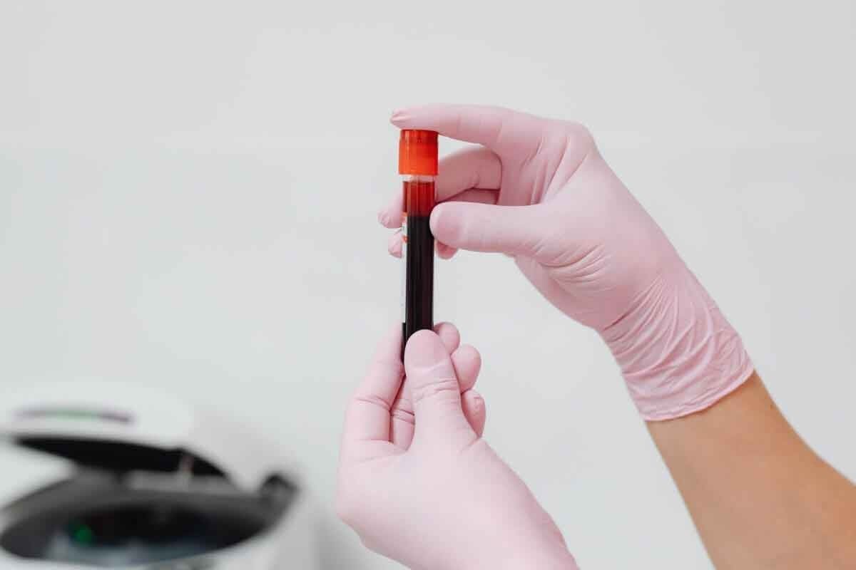 What Does HGB Measure in a Blood Test and Why Is It Important?