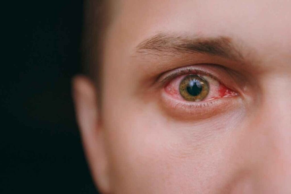 Blood Vessel Break in the Eye vs. Pink Eye: What’s the Real Difference? 1 Blood Vessel Break in the Eye vs. Pink Eye: What’s the Real Difference?