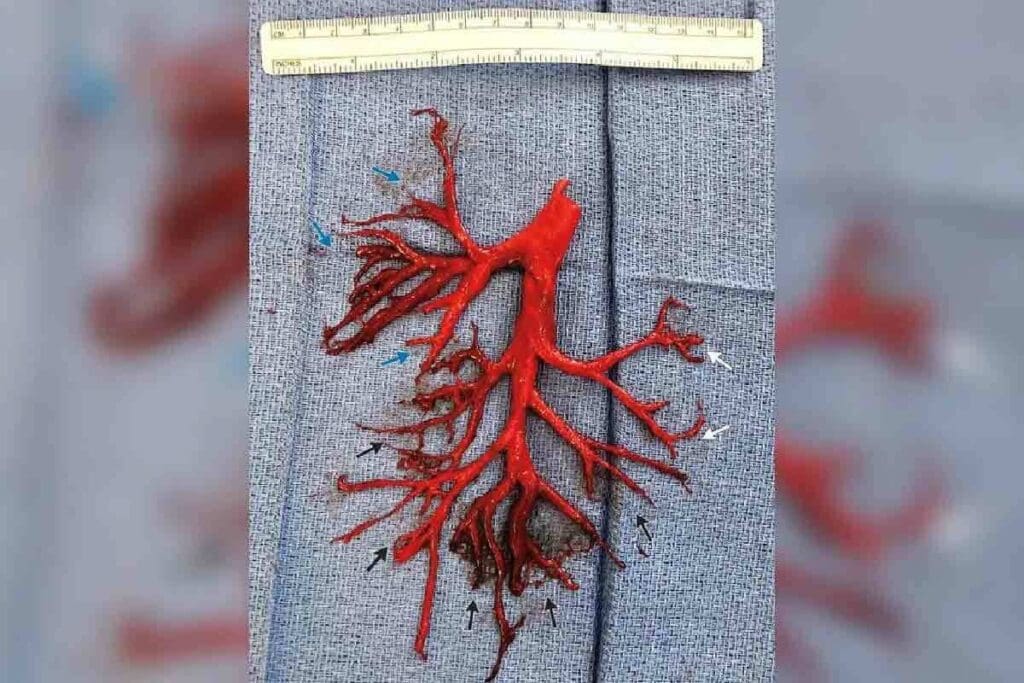 Blood Clot in Arm: 7 Key Symptoms and Risks You Should Know