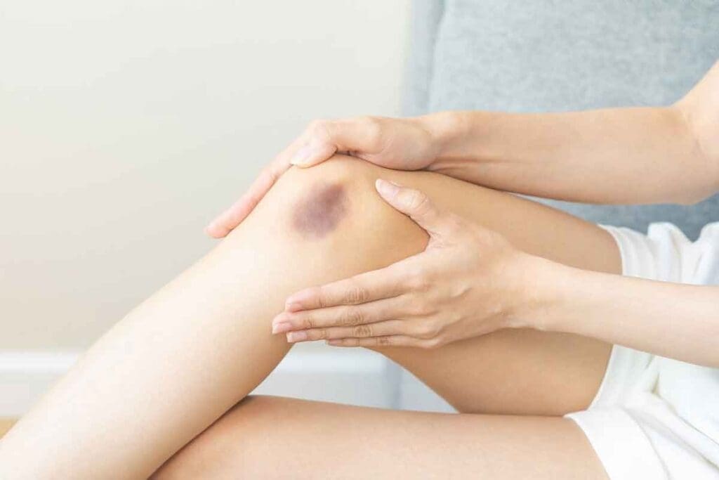 Contusion Blood Clot: Can a Bruise Lead to a Blood Clot After Injury?