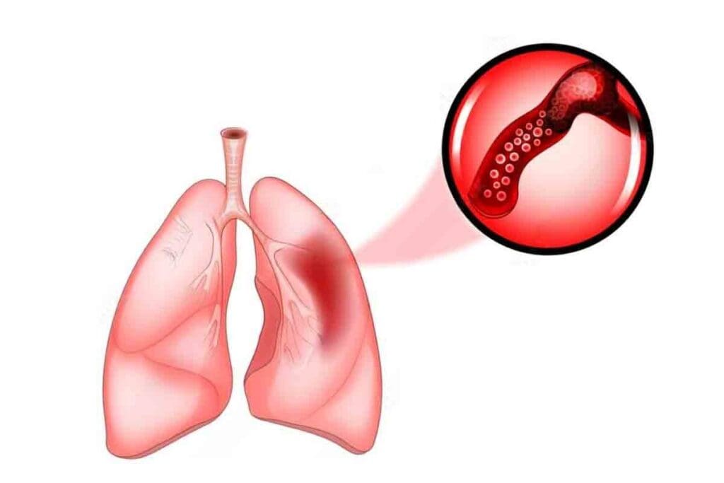 Blood in Lungs: 5 Critical Facts About Pulmonary Hemorrhage Causes and Symptoms 3 Blood in Lungs: 5 Critical Facts About Pulmonary Hemorrhage Causes and Symptoms