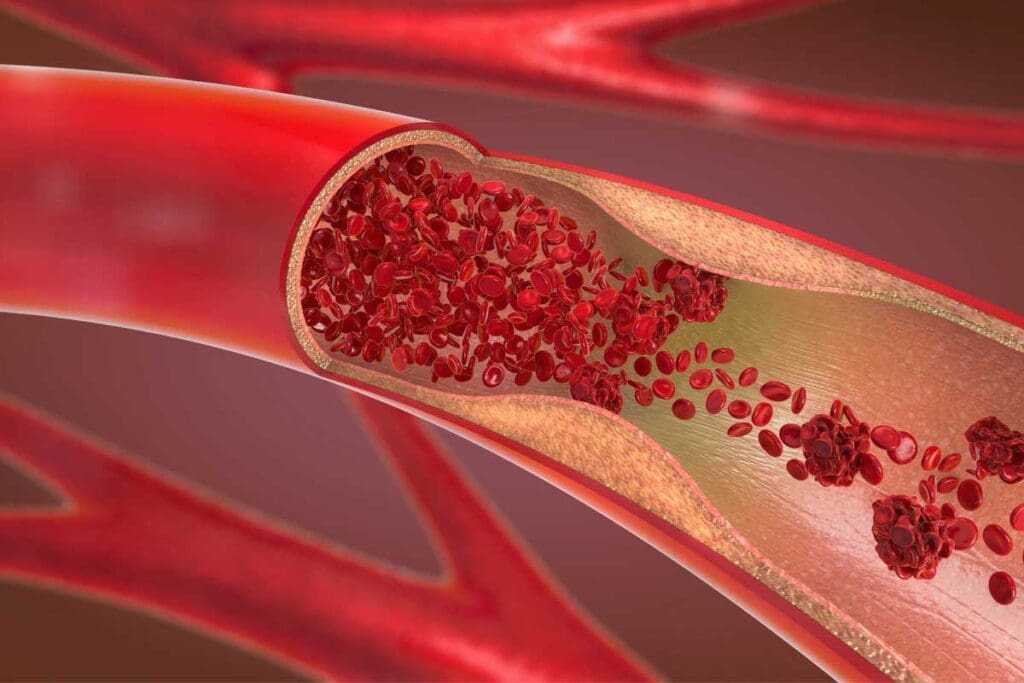 8 Key Facts About Blood Clot in Vein in Groin: Symptoms, Risks, and Treatment