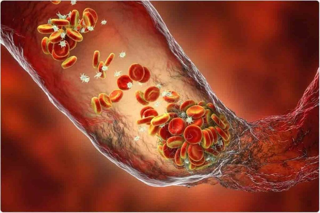 5 Types of Thrombosis: Quick Guide to Common Blood Clot Diseases