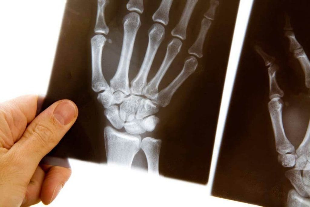 Can MRI Show Broken Bones That X-Ray Can't?
