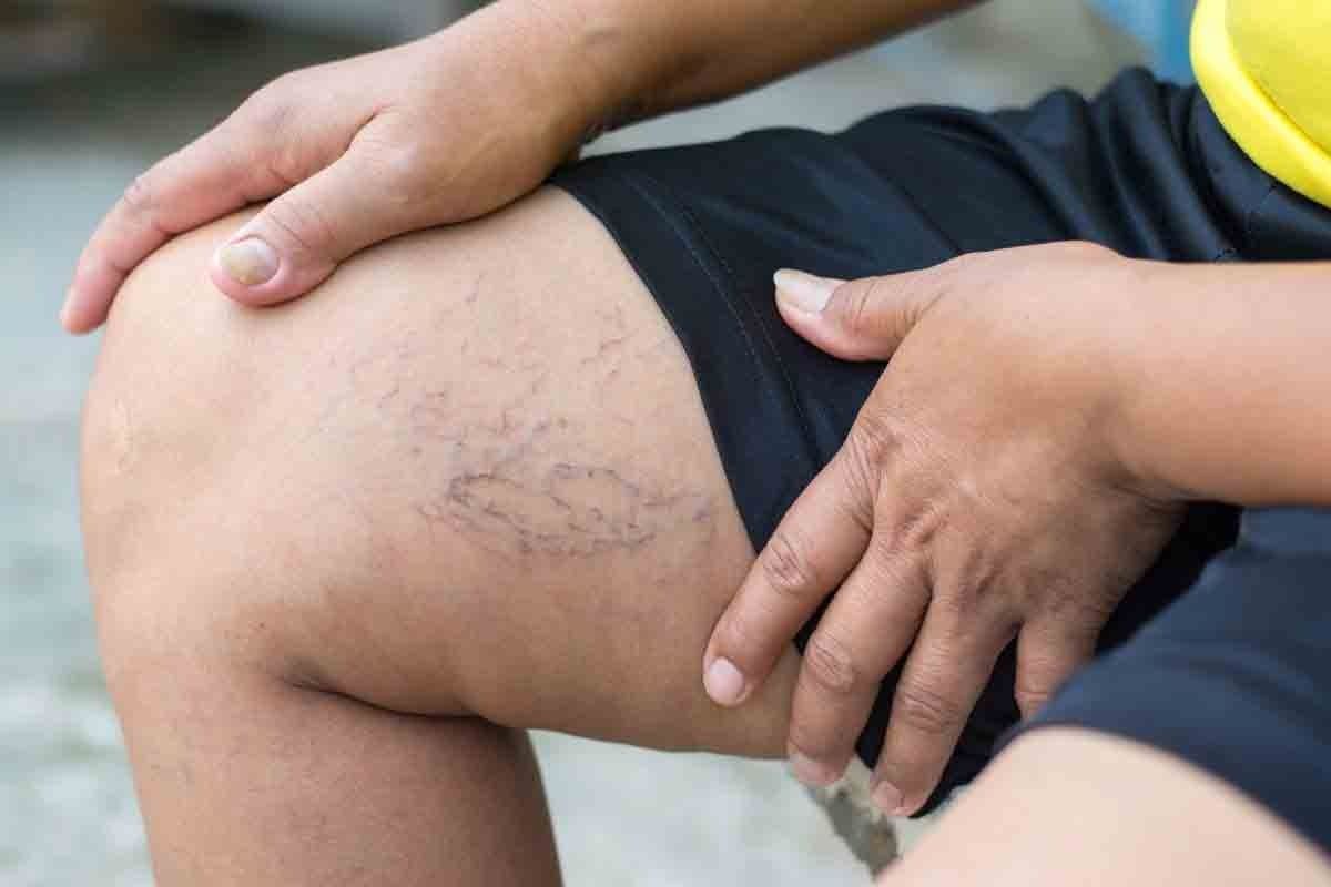 How to Dissolve Blood Clots in Legs