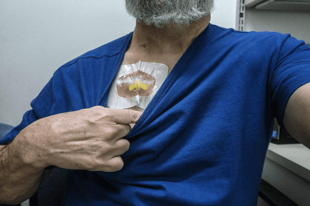 Understanding where chemo port goes in the body