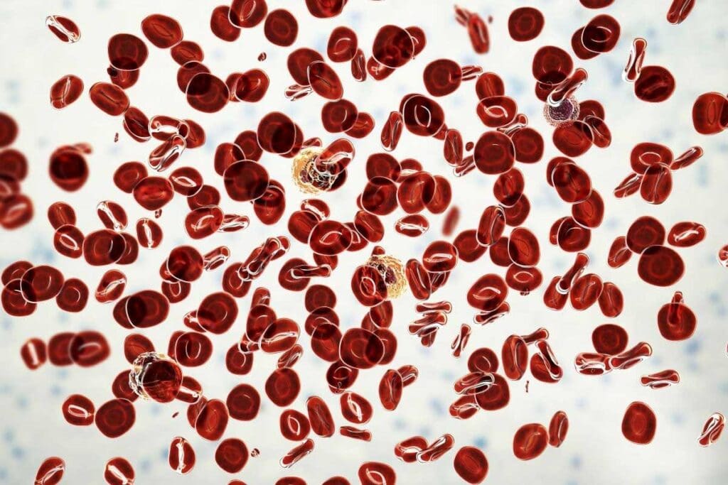 Aplastic Anemia Blood Smear: Crucial Lab Findings