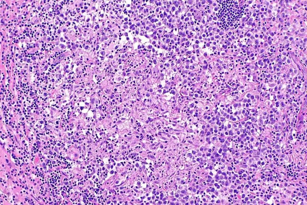 Pancytopenia Vs Aplastic Anemia: Key Differences & Labs