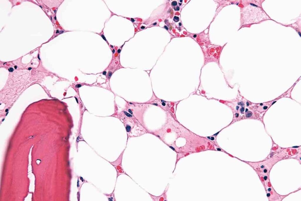 Aplastic Crisis Vs Aplastic Anemia: Key Differences Explained