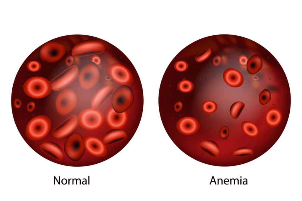 Autoimmune Hemolytic Anemia Relapse: Best Guide