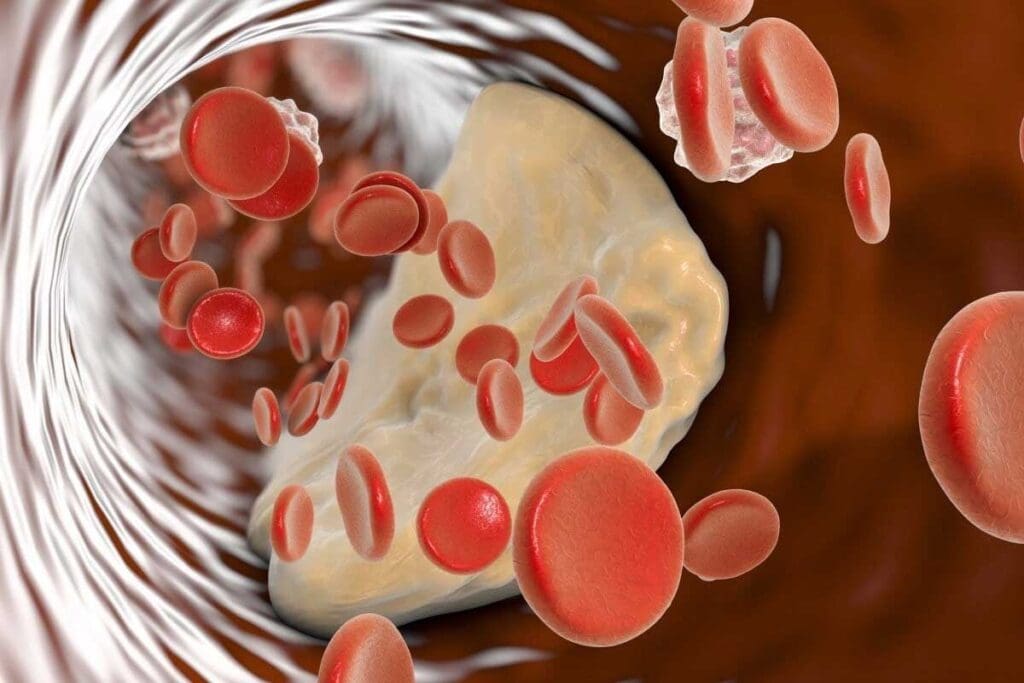 What Is The Cause Of Acute Lymphoblastic Leukemia: Key Risks 2 What Is The Cause Of Acute Lymphoblastic Leukemia: Key Risks