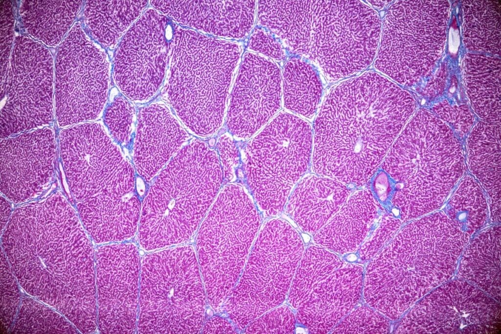 how serious is acute lymphoblastic leukemia