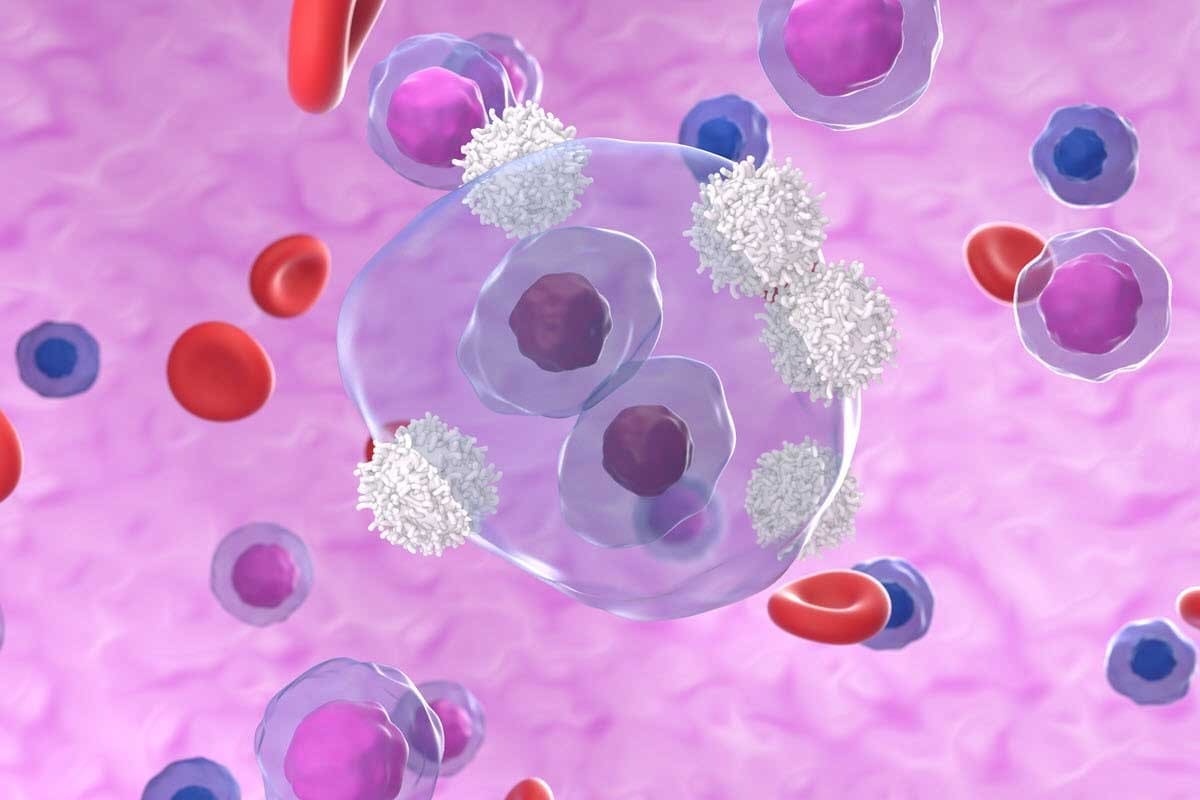 Precursor B Cell Acute Lymphocytic Leukemia: Key Symptoms