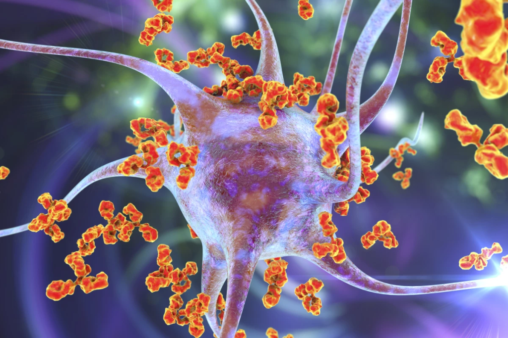 Is Fibromyalgia an Autoimmune Disease?