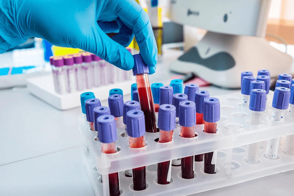 Blood Hemogram Test: The Ultimate Guide
