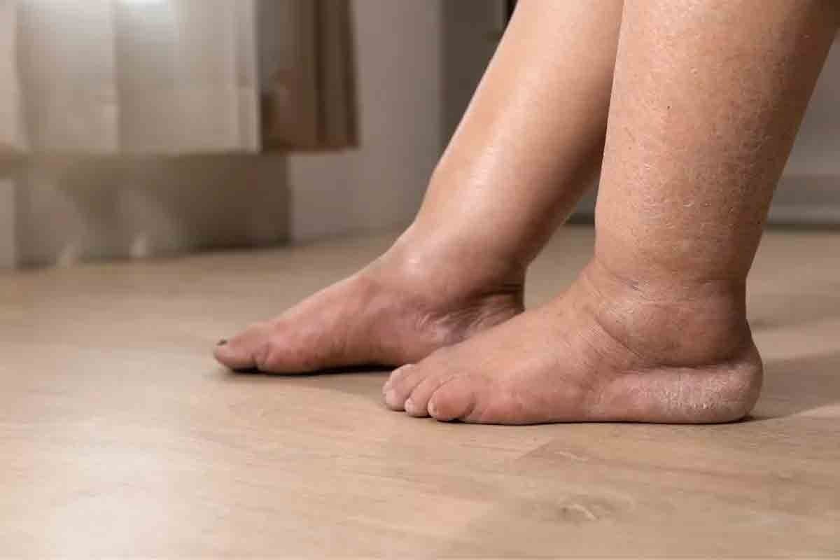 Anemia Leg Swelling: Crucial Causes of Edema Explained