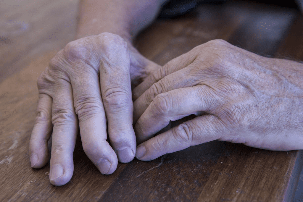 Blood Test for Autoimmune Disease: Signs & Results