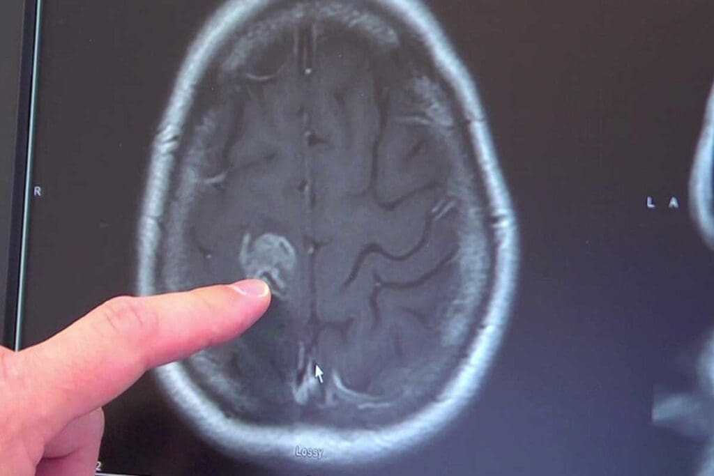 Cerebellum Brain Tumor Symptoms: 13 Key Warning Signs 1 Cerebellum Brain Tumor Symptoms: 13 Key Warning Signs