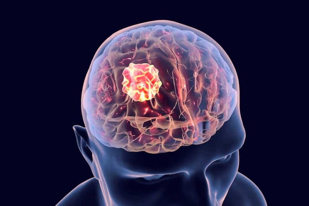 What Causes a Brain Tumor to Form in Adults?