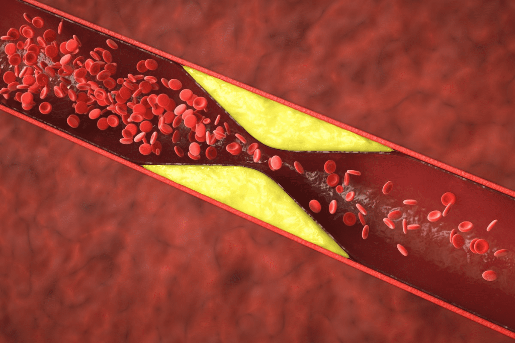 Hemophilia: Surprising Rare Clot Disorder