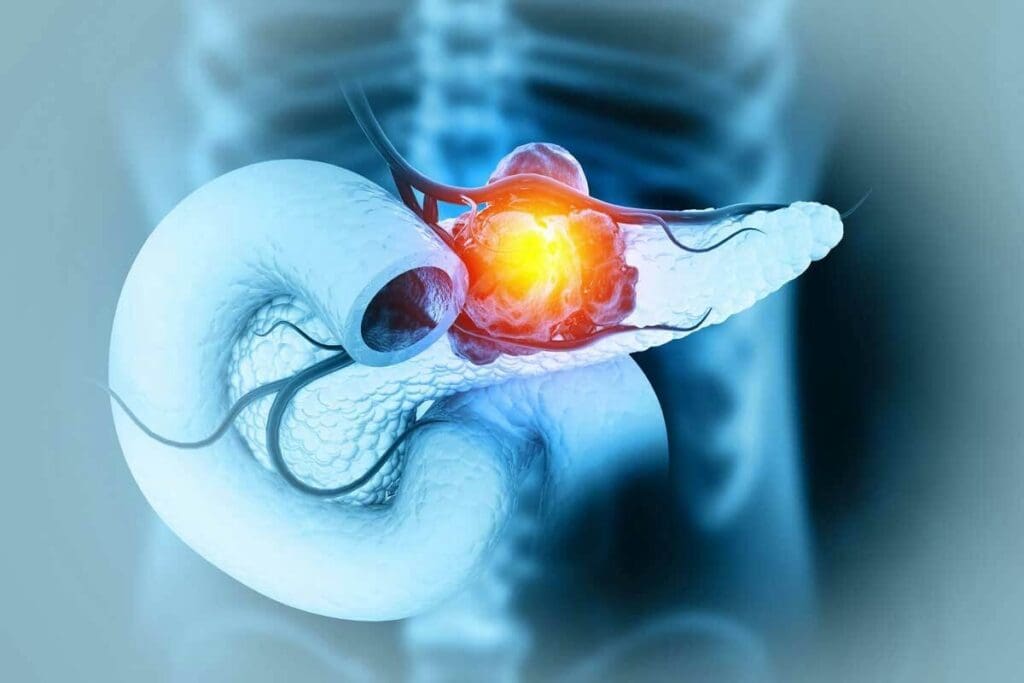 Adenocarcinoma Chemotherapy Treatment: 5 Key Drugs