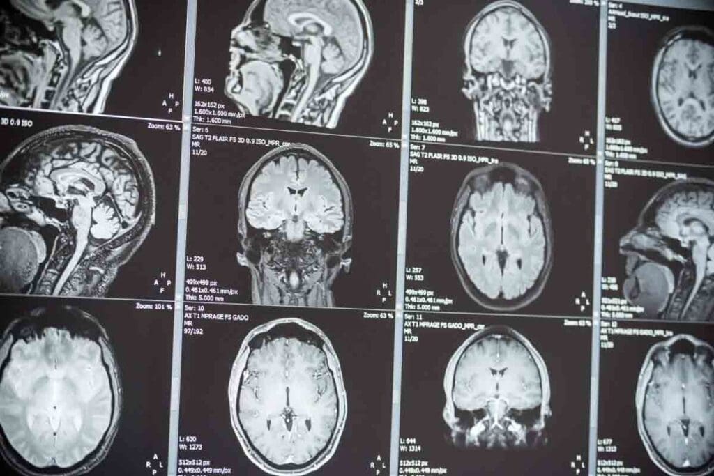 Brain Tumor Age Group: 13 Key Survival and Prevalence Facts