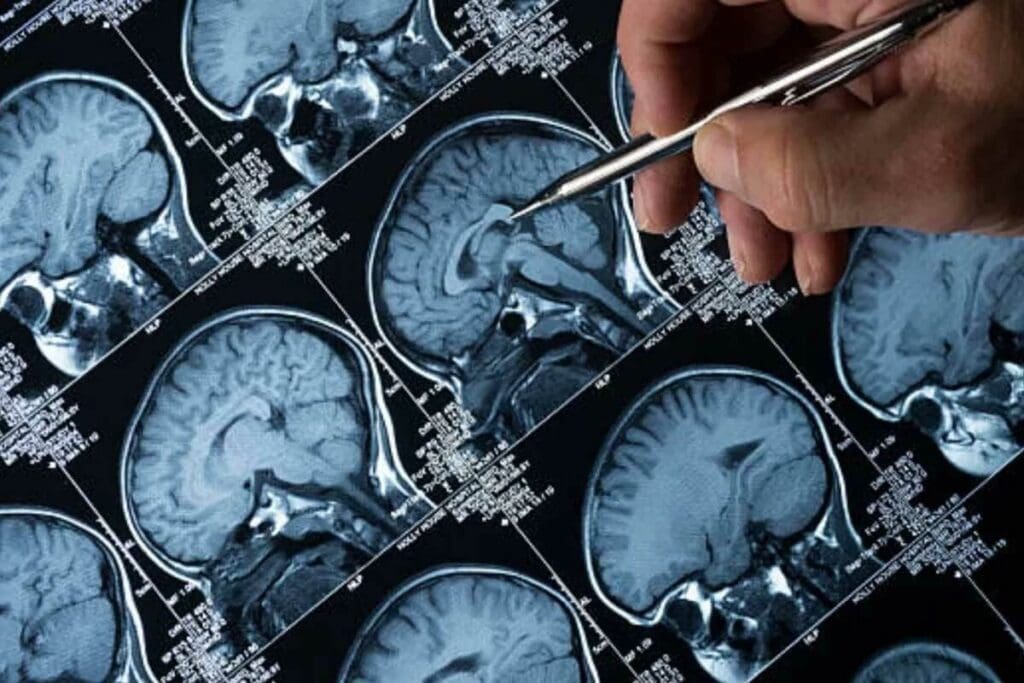 Early Stages of Brain Tumor: 7 Warning Signs to Spot Early