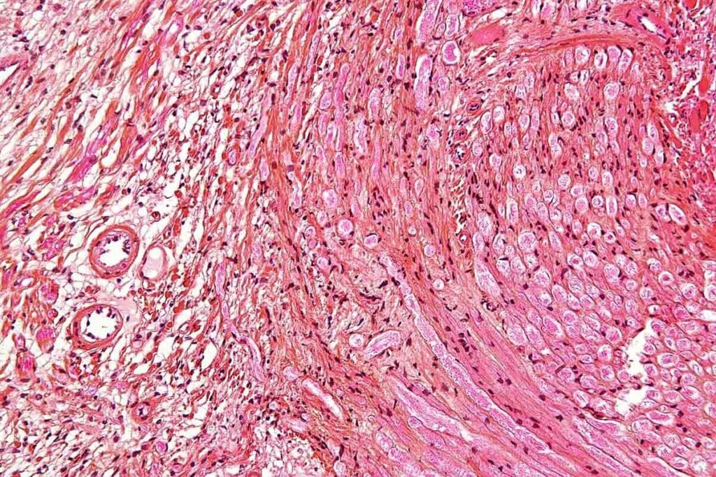 Tumor of Muscle Medical Term: Key Cancer Terminology Explained