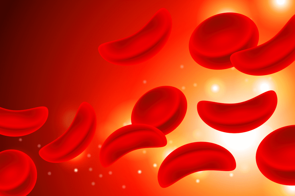 Sickle Cell Disease What Is “ Risks Explained
