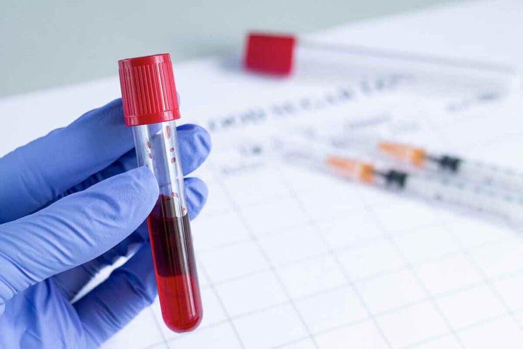 Polycythemia Blood Results: 7 Key Signs 1 Polycythemia Blood Results: 7 Key Signs