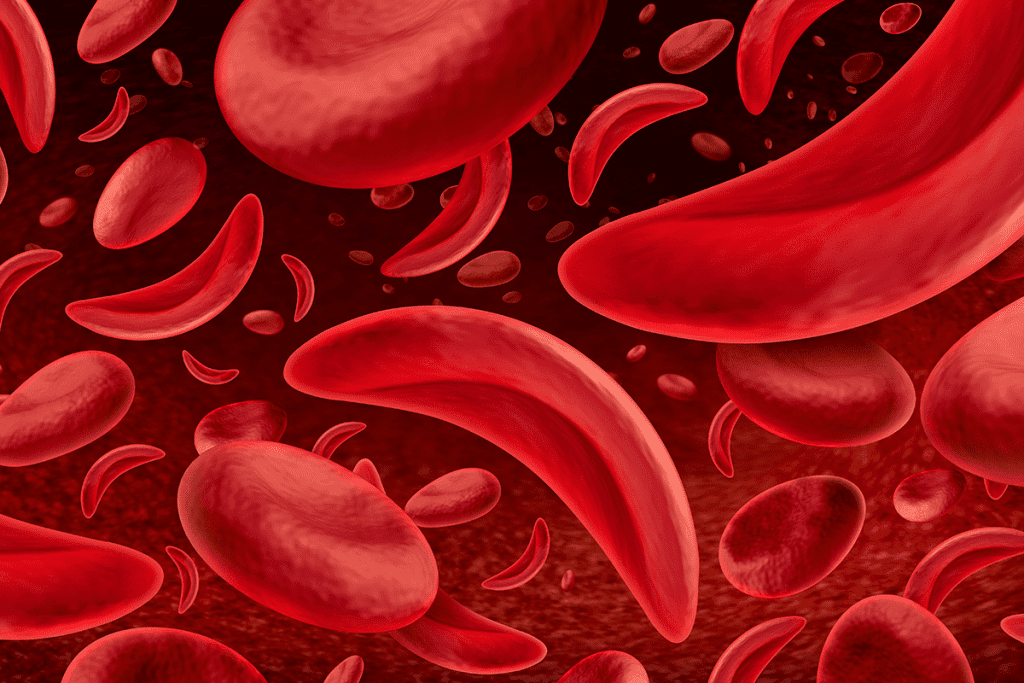 Sickle Cell Anemia: Expert Negative Causes