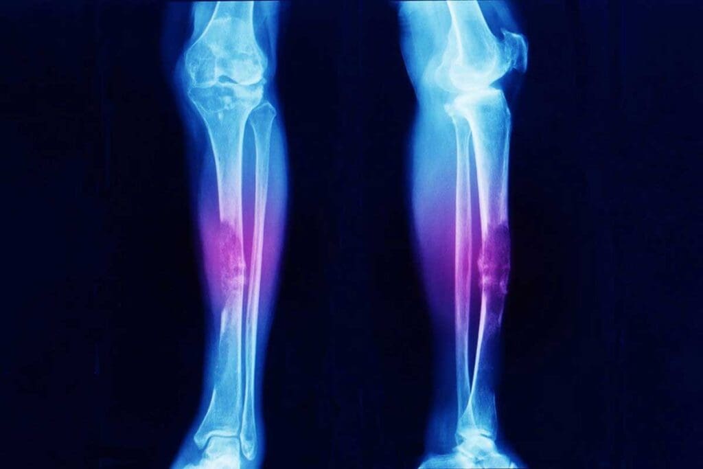 Early Sign Ewing Sarcoma Skin: 7 Key Signs 3 Early Sign Ewing Sarcoma Skin: 7 Key Signs